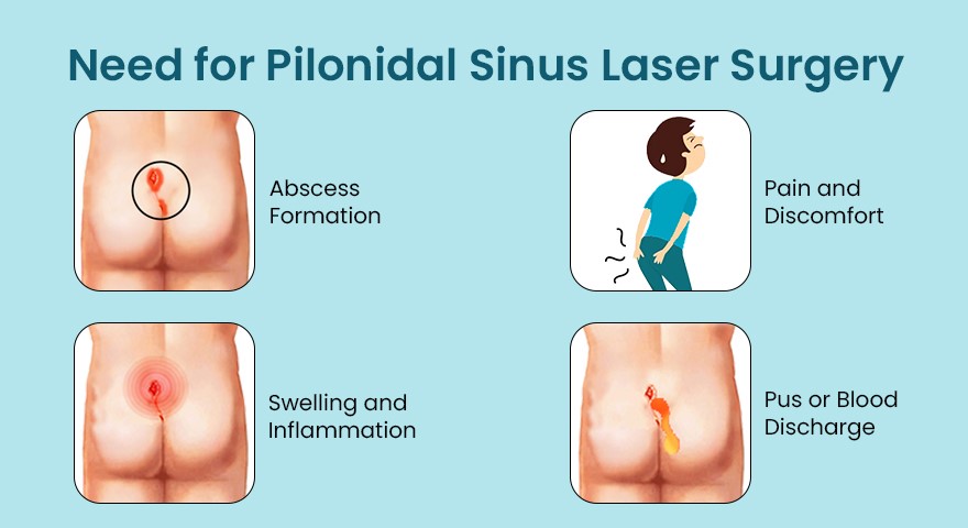 Need for Pilonidal Sinus Laser Surgery